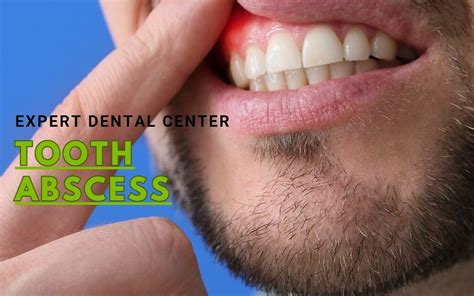tooth abscess