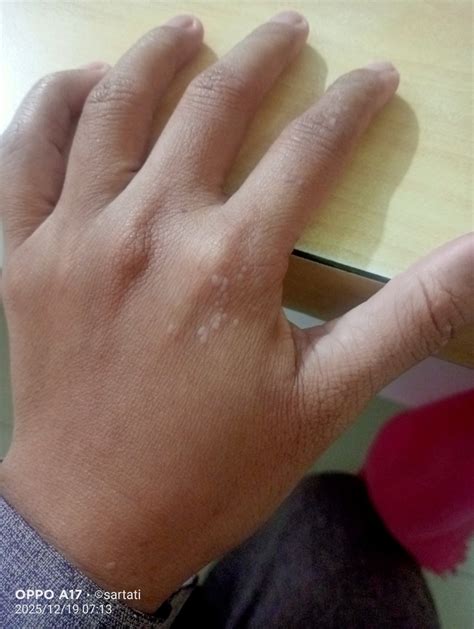 bintik putih tidak gatal  tangan hellosehat