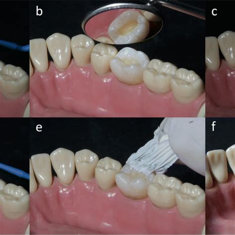 Rehabilitation of the occlusal surface with a resin-based composite ...