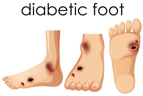 Diabetes Foot Artwork Clipart