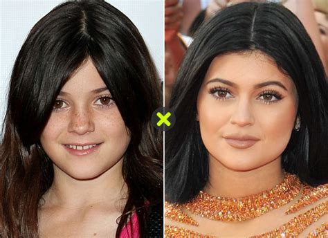 Kylie Jenner Antes E Depois - Kylie Jenner Antes E Depois Antes E Depois: Confira Como Irmãs