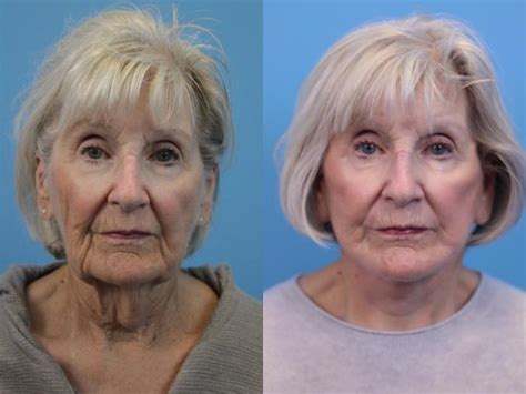 plastic surgery
