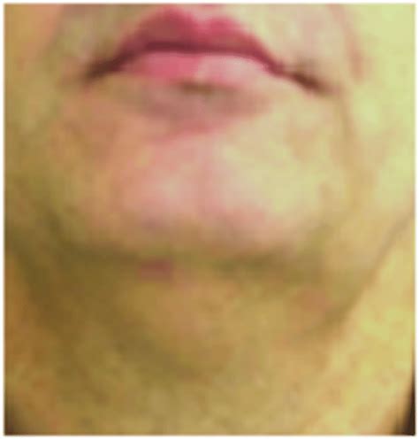 Extra-oral view showing left sublingual and submandibular swelling ...