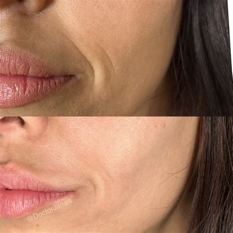 Smile Lines & Nasolabial Fold Fillers - Designer Aesthetics by Dr ...