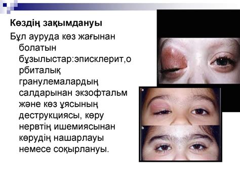Вегенер гранулематозы - презентация онлайн