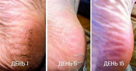 Лечение трещин на пятках