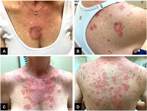 drug induced lupus mnemonic 1