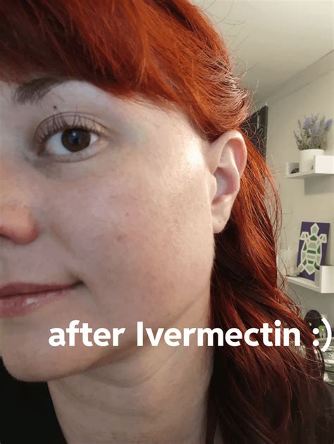 Ivermectin success!! So far: : r/Rosacea