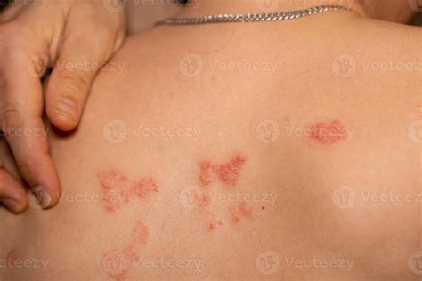 Understanding psoriasis and its effects on the skin with red, itchy