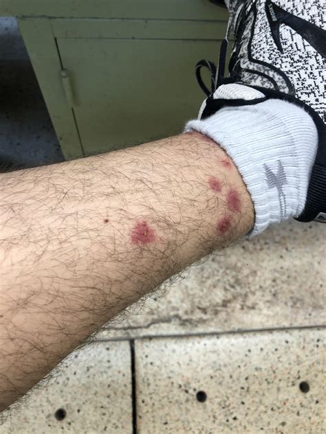 What kind of ant bites are these? : r/skin