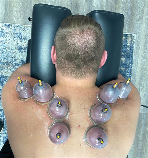 Training For Cupping Therapy 8