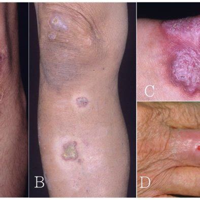 (PDF) Fish Tank Granuloma Caused by Mycobacterium marinum