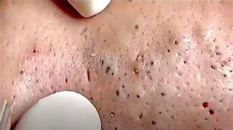 10 Shocking Facts About Unbelievable Blackhead Removal 2024 You Won’t Believe! - ok3fkhg
