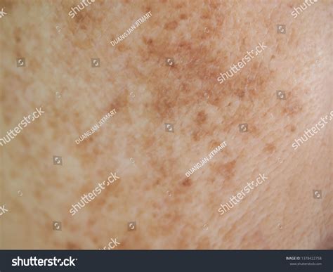 skin mark images stock  vectors shutterstock