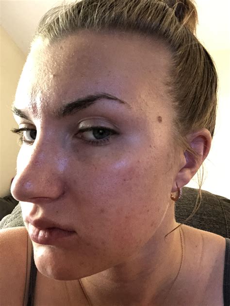 giant blackheads popping 4