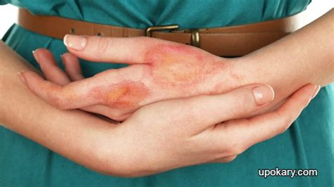 home remedies  heal minor burns upokary