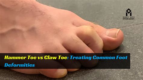 claw toe  hammer toe deformity  willie liggins blog