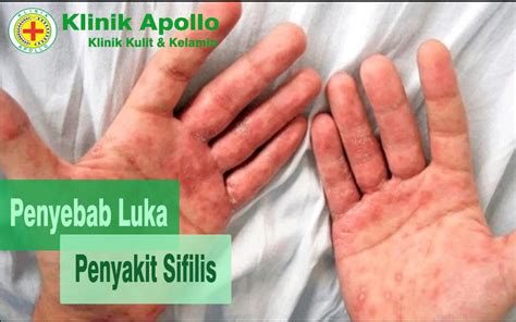 menyebabkan luka penyakit sifilis