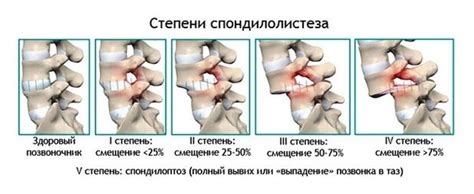 Листез позвоночика — alisastd.ru