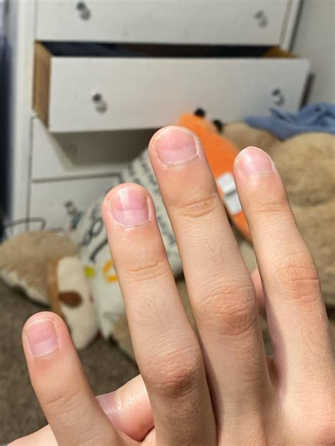 Weird discoloration under fingernails : r/DiagnoseMe