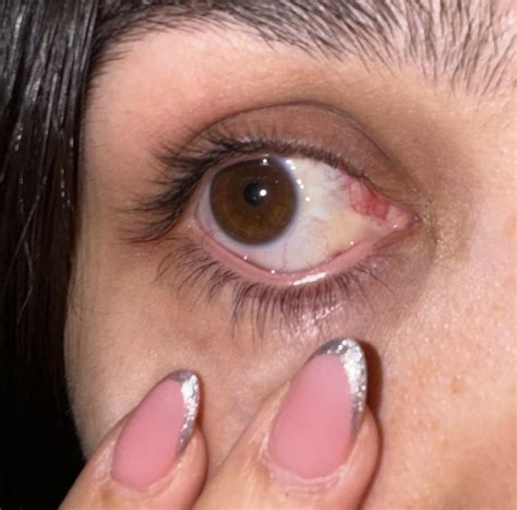 Eye leaking pus : r/AskDoctorSmeeee