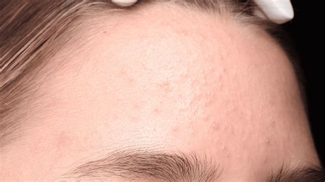 HydraFacial Treatment Sydney | The Face Bar Sydney