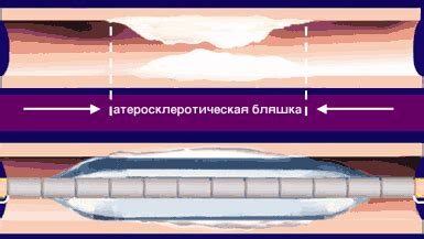 Баллонная, коронарная ангиопластика, коронарное стентирование сосудов ...