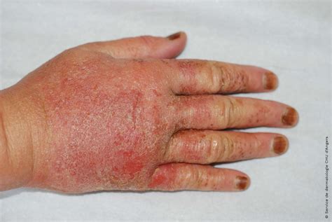 Eczema on the hands | Eczema Foundation