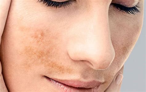 Los 8 problemas de la piel más comunes en las mujeres