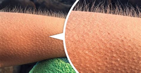 Goosebumps Serve as an Important Function in Our Bodies, and Scientists ...
