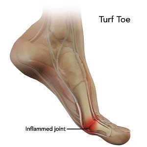 Turf Toe Treatment Kansas City | Big Toe Injury Treatment Overland Park KS