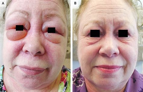 periorbital edema  dermatomyositis   year  woman presented