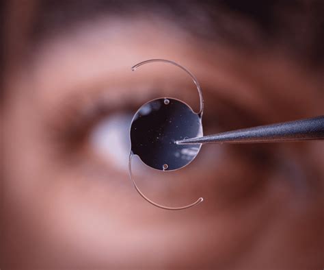 Lens Implant Surgery St Petersburg, FL - Intraocular Lenses