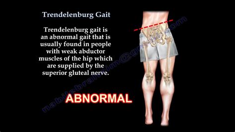 Trendelenburg Gait - Everything You Need To Know - Dr. Nabil Ebraheim ...
