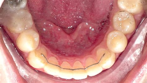 hate replacing broken retainers  maintain dual retainer  life