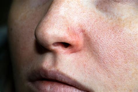 broken blood vessels on face how to get rid of 2
