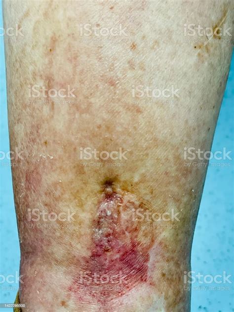 ulcer leg stock photo  image  ulcer leg vein istock
