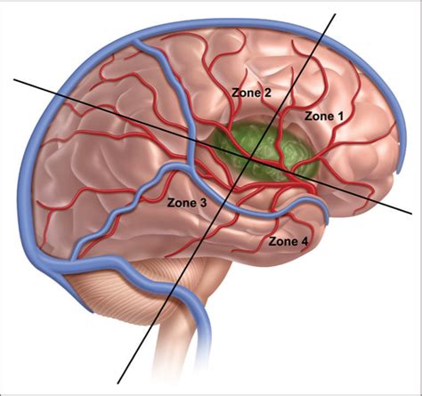 Surgical Neurology International