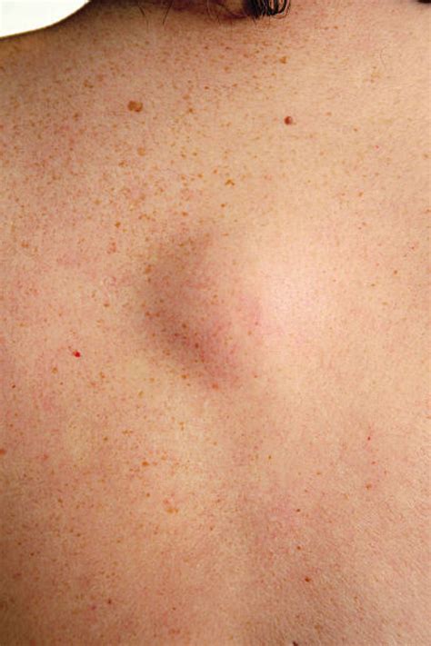 Lumps, Bumps, Skin Tags and Liposuction - HN Magazine