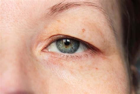 drooping eyes  symptoms  treatment auckland nz palm clinic
