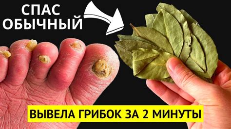 От ГРИБКА НОГТЕЙ можно избавиться НАВСЕГДА за 2 минуты простым... Это ...