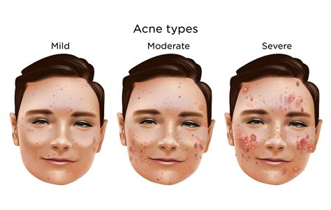Moderate Acne | My Doctor Online