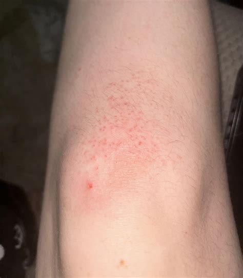 Ive had these itchy tiny bumps on my knees for about a year now and is