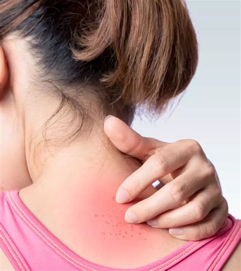 Ice Burn: Causes, Symptoms & 11 Home Treatment Tips