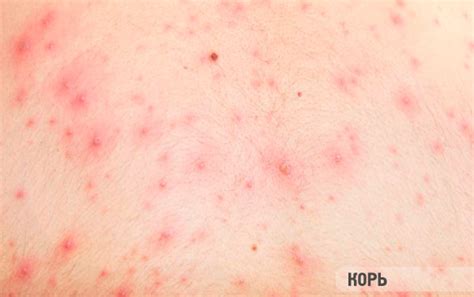 Червени петна по краката: причини и патогенеза
