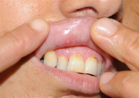 Pemfigus Nedir? | Eksimum