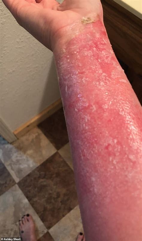 Woman, 28, who suffered severe burns when pressure cooker exploded, has ...