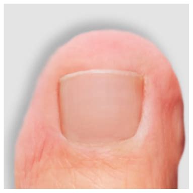 nail fungus toenail fungus questionnaire