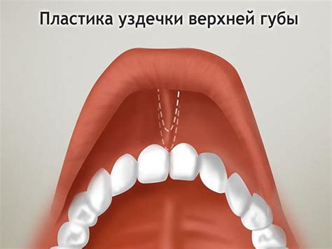 Пластика уздечки верхней губы: лазерная и другие виды коррекции у детей ...