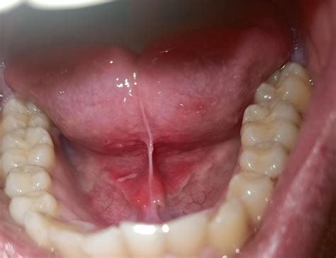 Floor of my mouth started hurting in the past 2 days. Decided to take a